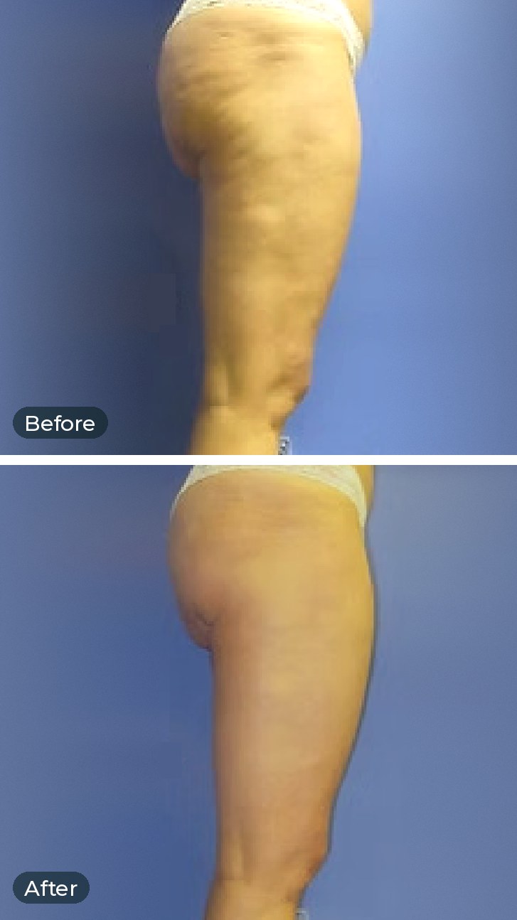 Thighs before and after five one-hour Endermologie sessions