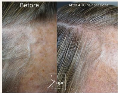 Thinning hairline before and after four TargetCool® sessions