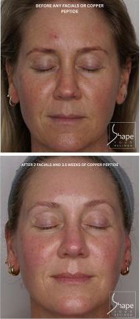 Skin tone before and after two facials and copper peptide home care