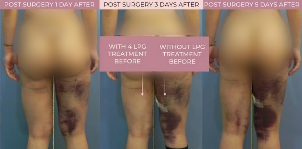 Liposuction recovery at 1, 3 and 5 days after surgery. The leg treated with four LPG sessions before surgery shows far less bruising than the untreated leg.